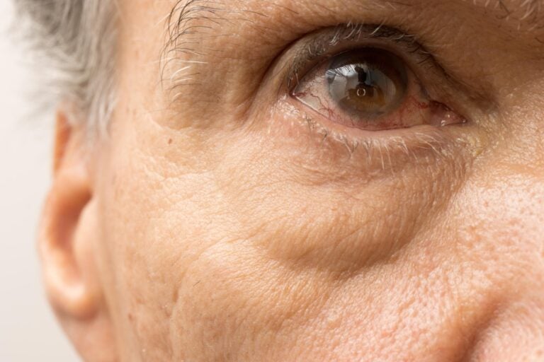 Close Up of Elderly Eye Receiving Vision Screening during Respite Care